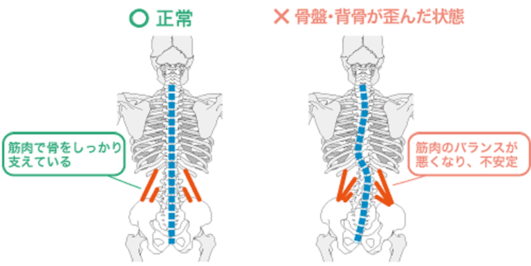 正常な背骨と、歪んだ背骨の状態